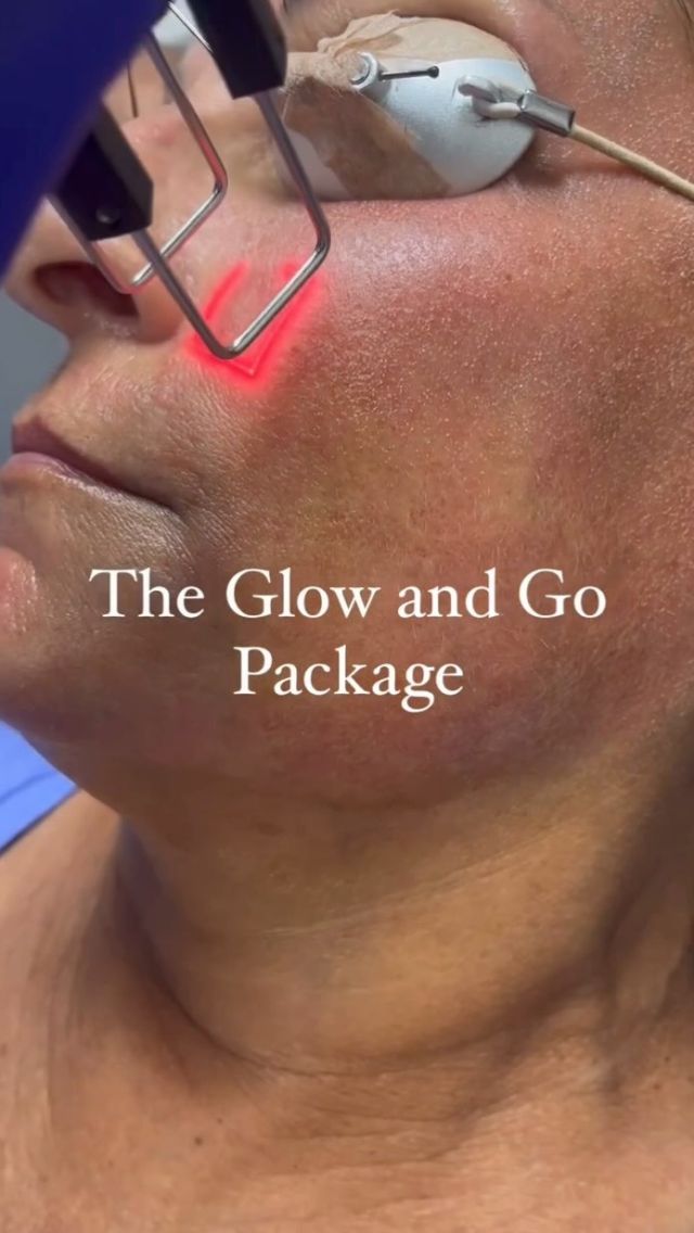 A sneak peek into our Glow and Go Package at Rosenthal Cosmetic and Plastic Surgery! This package includes RF Microneedling preformed by our Medical Esthetician, Cornelia. The C02 Laser is preformed by one of our board certified Plastic Surgeons. 

A series of 3 comfortable treatments with minimal to no down time. Paired with a complimentary AnteAge Growth Factor Serum to keep your skin aglow! 

Click on the link in our bio to schedule and appointment today! 

#drrosenthal #rosenthalcosmeticandplasticsurgery #southfloridaplasticsurgery #southfloridaplasticsurgeon #palmbeachplasticsurgery #rhinoplasty #breastaugmentation #boobjob #nosejob #southfloridanosejob #southfloridaboobjob #southfloridabotox #southfloridafiller #cosmeticsurgery #southfloridadermatology #southfloridamedspa #southfloridamedicalspa #medspa #southfloridabodysculpting #southfloridaesthetician #southfloridafacials #mommymakeover #southfloridamommymakeover