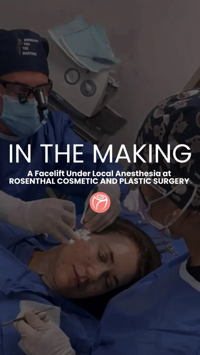 A new level of confidence IN THE MAKING at Rosenthal Cosmetic and Plastic Surgery! 🌟 It was an honor to perform Angela’s in-office Facelift under local anesthesia! Experience the magic of rejuvenation without the need for general anesthesia. Dr. Rosenthal ensures a comfortable and personalized procedure, tailored to enhance your natural beauty. Say goodbye to sagging skin and hello to a refreshed, youthful appearance! Book your consultation today and let us help you achieve the confidence you deserve. 💖 

#rosenthalcosmeticandplasticsurgery #facelift #inofficefacelift #southfloridafacelift #palmbeachfacelift #localanaesthetic #localanasthesia #plasticsurgerybeforeandafter #plasticsurgeons #palmbeachplasticsurgery #palmbeachplasticsurgeon #faceliftbeforeandafter
