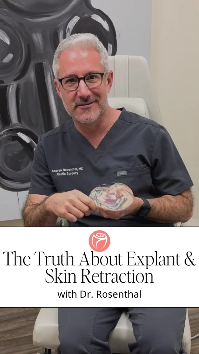 🎥 “If you’re thinking about taking your implants out, don’t panic. Here’s what really happens during explant surgery.” – Dr. Rosenthal

A lot of women worry they’ll look deflated or stretched out after removing their implants—but that’s not always the case.

💡 Here’s what to know:
In many cases, explant surgery happens in two stages. The first step is removing the implants themselves. Once they’re out, the natural breast tissue often retracts and reshapes on its own—especially if the implants weren’t overly large.

✨ That “stretched out” look you’re afraid of? It’s not guaranteed. In fact, the skin and tissue frequently bounce back better than you’d expect.The most important thing? A tailored approach based on your goals, anatomy, and lifestyle.

💬 Considering an explant or want a second opinion? Dr. Rosenthal is here to listen, guide, and help you make the decision that’s right for you.

#RosenthalCosmeticAndPlasticSurgery #ExplantSurgery #BreastImplantRemoval #DrRosenthal #PlasticSurgeryEducation #ImplantRemovalJourney #PatientCenteredCare #SouthFloridaPlasticSurgeon #BreastLift #NaturalResults #ExplantSupport #ConfidenceInCare #YourBodyYourChoice