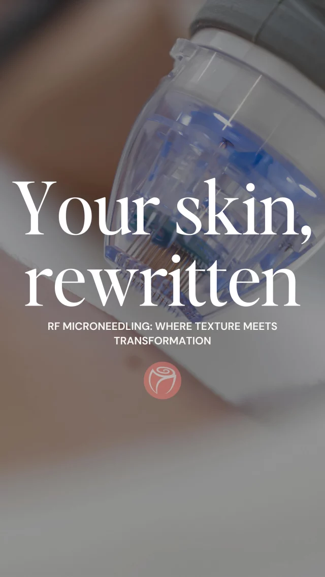 ✨ Reasons Why You Should Do Microneedling ✨

Microneedling is one of our favorite treatments because it works on so many levels:
✔ Stimulates collagen production
✔ Improves skin texture and tone
✔ Minimizes large pores
✔ Lightens dark spots & scars
✔ Softens fine lines & wrinkles
✔ Brightens your overall complexion

It’s the ultimate skin reset for a smoother, younger-looking glow. 🌟

📲 Book your microneedling treatment today and see the results for yourself!

#RosenthalCosmeticAndPlasticSurgery  #Microneedling #SkinHealth #GlowingSkin