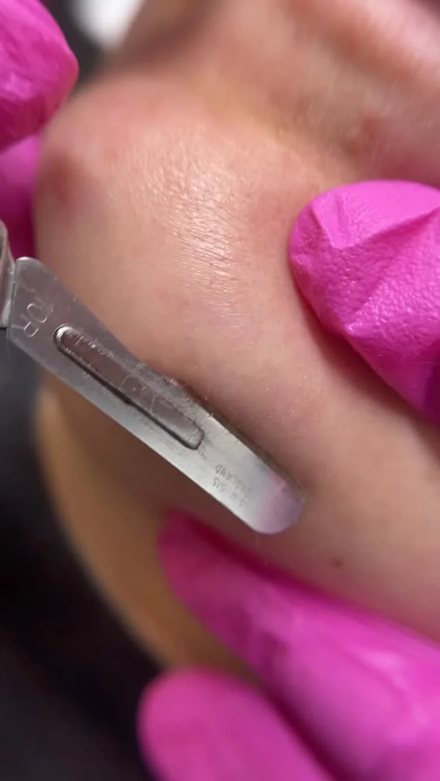 Your best results don’t come from doing everything at once. They come from doing things in the right order.

A thoughtful aesthetic plan focuses on sequencing treatments so each one builds on the last. Tox to soften movement. Filler to restore balance and structure. Laser to improve tone and texture. Facials to maintain, support, and extend your results.

This approach allows your skin to heal properly, look more natural over time, and deliver smoother, longer-lasting outcomes without overwhelm.

We believe in intentional care, not rushed decisions. Let’s create a plan that works with your skin, not against it.

#RosenthalCosmeticAndPlasticSurgery #AestheticRoadmap #NaturalResults #InjectablesExpert #SkinPlanning