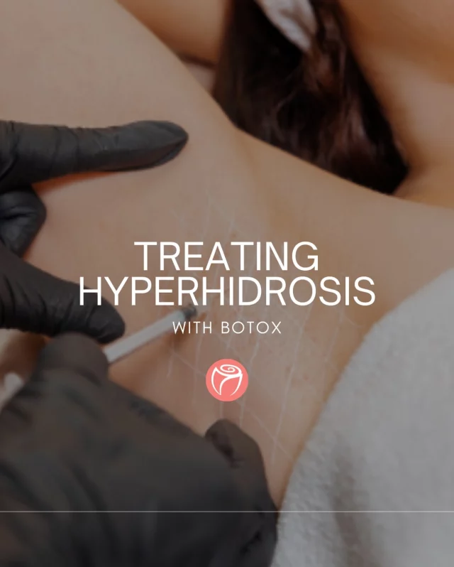 Excessive sweating is more common than you think and it’s completely treatable.

If you struggle with underarm sweating that soaks through clothing or affects your confidence, Botox can help. By targeting the sweat glands beneath the skin, it significantly reduces sweat production in the treated area, keeping you dry for months at a time.
The treatment is quick, minimally uncomfortable, and requires little to no downtime. Most patients see noticeable improvement within days.

Ready to feel confident in every outfit? Schedule your consultation to see if hyperhidrosis treatment with Botox is right for you.

#RosenthalCosmeticAndPlasticSurgery #HyperhidrosisTreatment #BotoxForSweating #ExcessiveSweatingRelief #SouthFloridaMedSpa