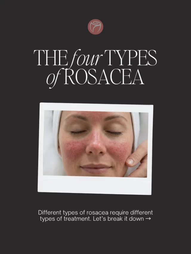 April is Rosacea Awareness Month. But rosacea doesn’t look just one way.

There are four recognized types, and many patients experience a combination which is why proper diagnosis matters.

Type 1: Persistent redness, flushing, visible capillaries, and sensitivity Type 2: Red bumps and pustules often mistaken for acne Type 3: Thickened, textured skin, most commonly around the nose Type 4: Eye involvement with dryness, irritation, and redness

If your skin feels reactive, looks consistently flushed, or isn’t responding to typical acne treatments, it may not be acne at all.

The good news is rosacea can be managed with the right approach. Treatment focuses on calming inflammation, strengthening the skin barrier, and protecting against triggers.

If you’re unsure what you’re dealing with, we can help you identify your type and create a plan that actually works.

#RosenthalCosmeticAndPlasticSurgery #RosaceaAwarenessMonth #RosaceaTreatment #SensitiveSkinCare #MedicalAesthetics