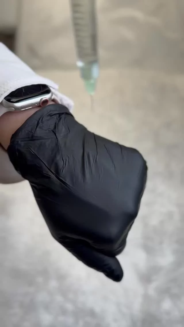 Not all fillers are the same and this is why.

What you’re seeing here is the consistency of a hyaluronic acid filler. That texture matters more than most patients realize.

Different fillers are designed with different densities and structures to achieve specific results:�• Softer, more fluid fillers for lips and under-eyes�• Medium-density fillers for natural contour and support�• Thicker, more structured fillers for lifting and defining areas like the jawline and cheeks

The way a filler flows, integrates, and holds shape determines how natural your results will look and feel. Choosing the right product is just as important as technique. It’s not about using more filler, it’s about using the right type in the right place. This is where experience and precision make all the difference.

#RosenthalCosmeticAndPlasticSurgery #DermalFiller #AestheticMedicine #FacialBalancing #NaturalResults